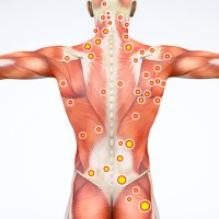 Trigger point